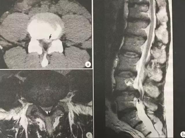 腰椎间盘突出的正确认识,腰椎间盘突出十大禁忌运动