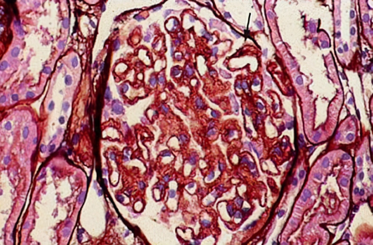 中药治疗肾病需要经常调整用药吗,名老中医治疗肾炎蛋白尿名方