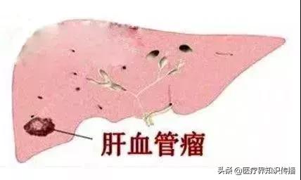 肝血管瘤中医治疗方法,肝血管瘤需要治疗么