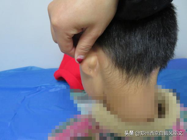 儿童白癜风停药后白斑又扩散了,白癜风儿童真实图片