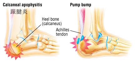 产后足跟痛是什么原因引起的,足跟痛是什么原因用什么贴