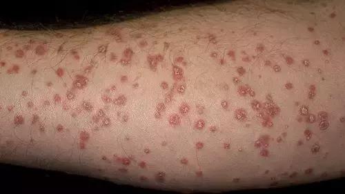 专治牛皮癣银屑病的外用药膏,治疗牛皮癣银屑病民间土方17种