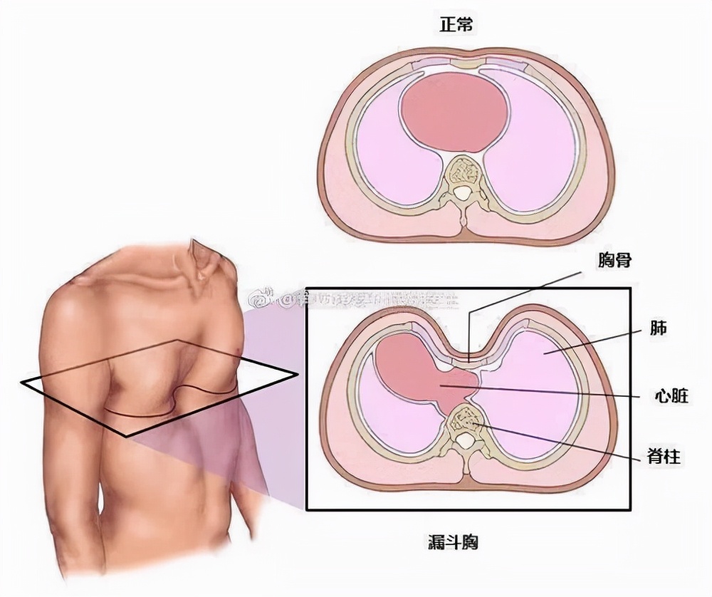 中国儿科医院漏斗胸,郴州市第一人民医院漏斗胸手术