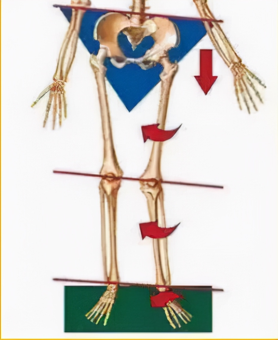 肥胖可能导致平足吗,肥胖真的能让人变矮吗