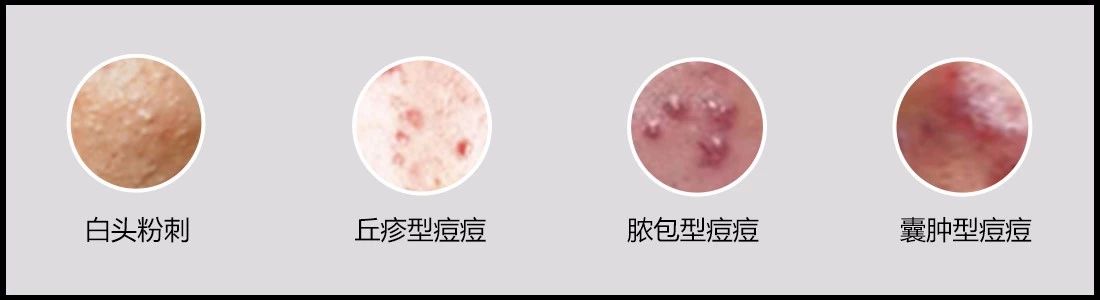 痘痘肌内调药膳,痘痘肌自律期应该怎么吃