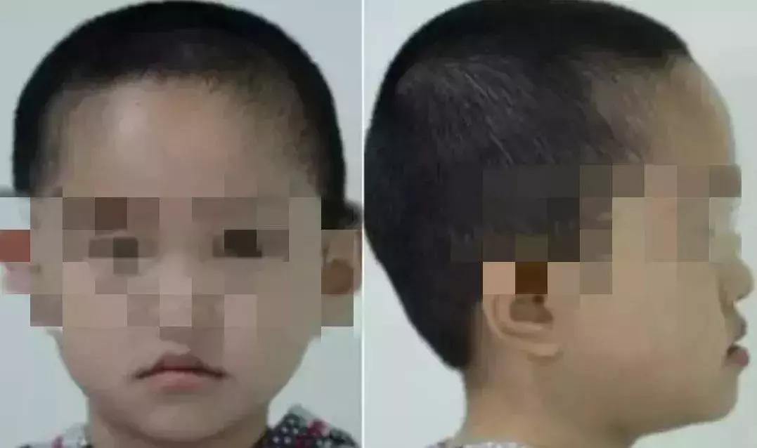 小朋友牙齿地包天矫正方法,牙齿地包天多大矫正最合适