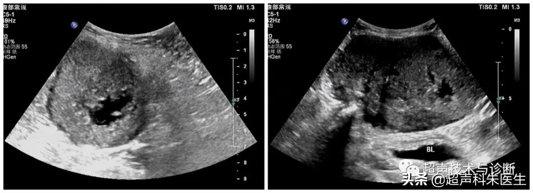 未婚女性卵巢查出包块,女左下腹有肿块是癌症吗