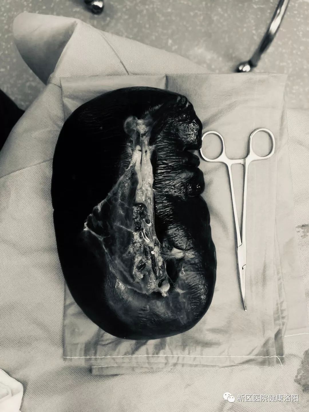 腹腔镜脾脏切除术体位,脾脏巨大能用腹腔镜手术切除吗