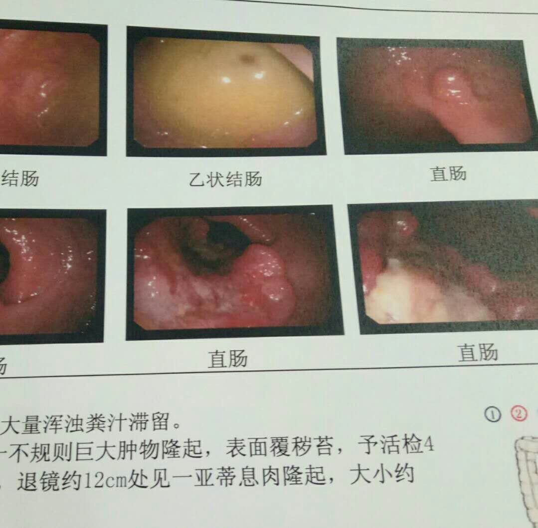 肠息肉发展为肠癌大约多久,肠息肉到肠癌要经过几个阶段