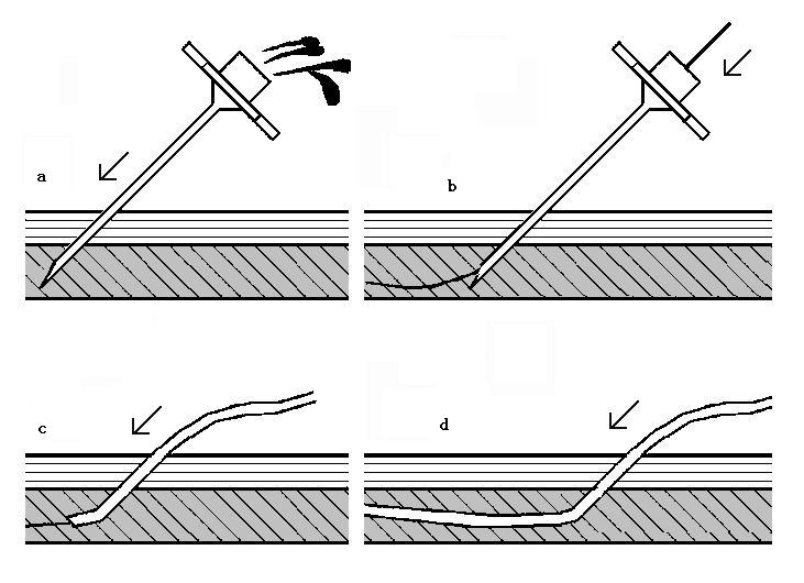 各种肿瘤并发症介入治疗,肿瘤和癌症早期怎么预防