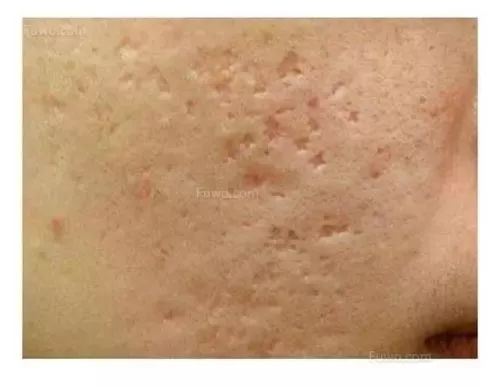 该怎样从源头上改善成人痘印痘坑,祛红痘印黑痘印医美