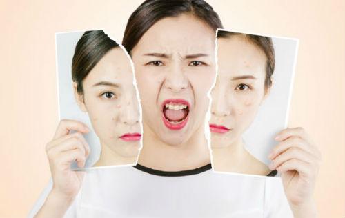 起痘痘后的黑印怎么去,有痘痘有痘印怎么祛