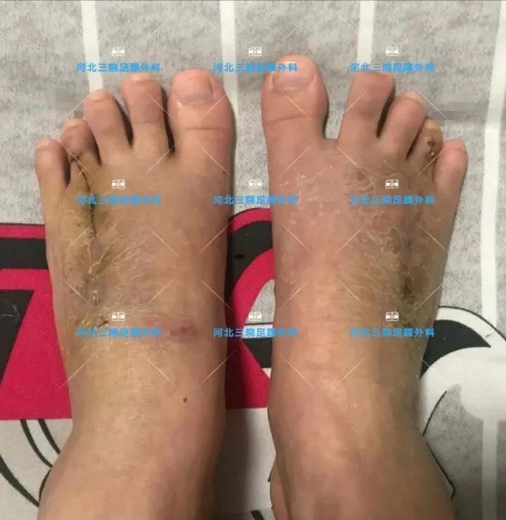 第四足趾短小怎么办,为什么第四脚趾短小