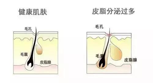 戴节育环和长痘有关系吗,淋巴长痘与肝有什么关系