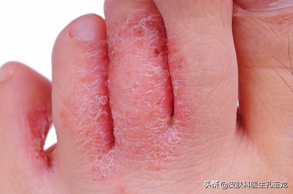 脚气皮肤科医生怎么说,皮肤科医生脚气小妙方