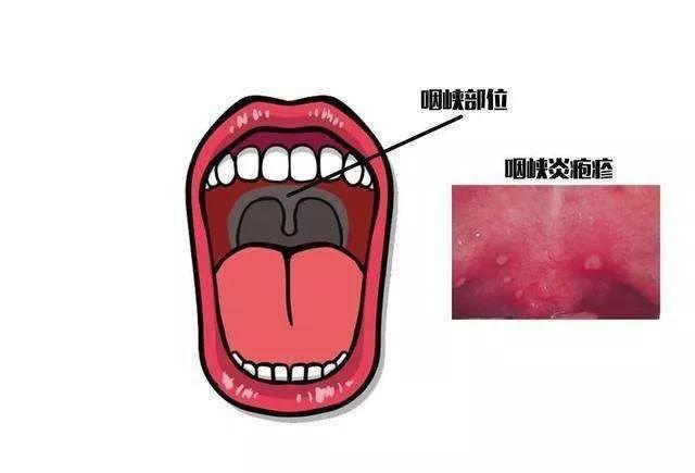 疱疹性咽峡炎阶段详解,疱疹性咽峡炎开始到结束的图片