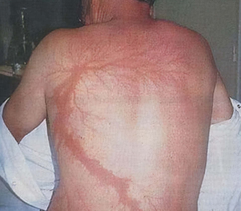 人被雷劈中会发生什么,人被雷劈过后会怎么样