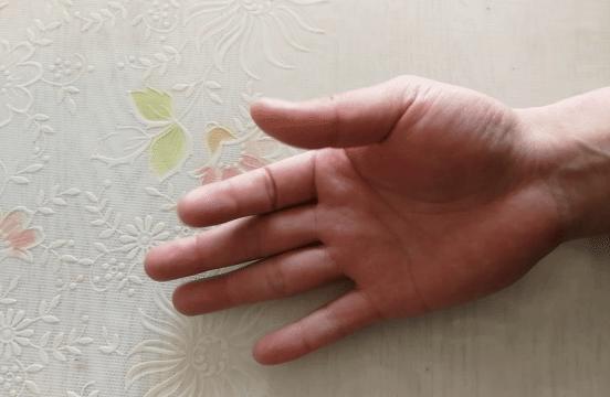 中年妇女手指疼痛僵硬是什么原因,老人手指腱鞘炎如何治疗