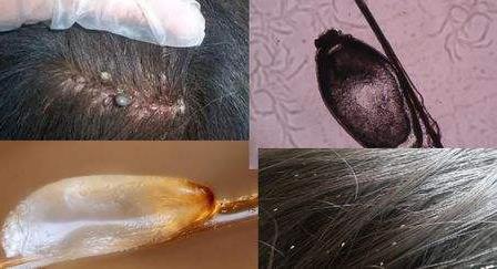 去头发虱子与虱子卵最有效方法,去除头上虱子和虱子卵最好小窍门