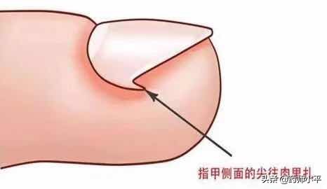 指甲长肉里疼怎么办,指甲往肉里长怎么办