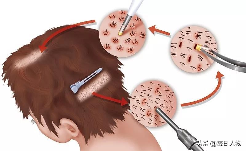 脱发知识普及,当代脱发现状