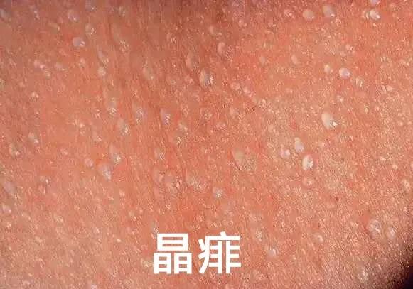 爽身粉去热痱子,长痱子用爽身粉可以去痱子吗