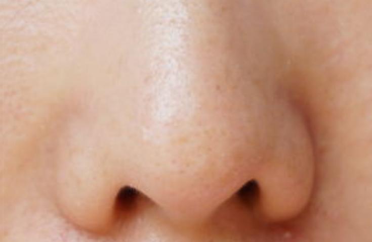 有黑头千万别乱用手挤,如果有黑头闭口痘痘怎么办