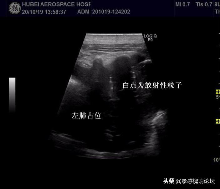 湖北航天医院成功开展超声引导下放射性粒子植入技术