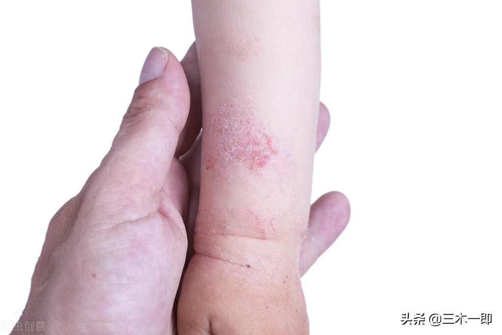 孩子湿疹的原因及处理方法,儿童湿疹治愈过程