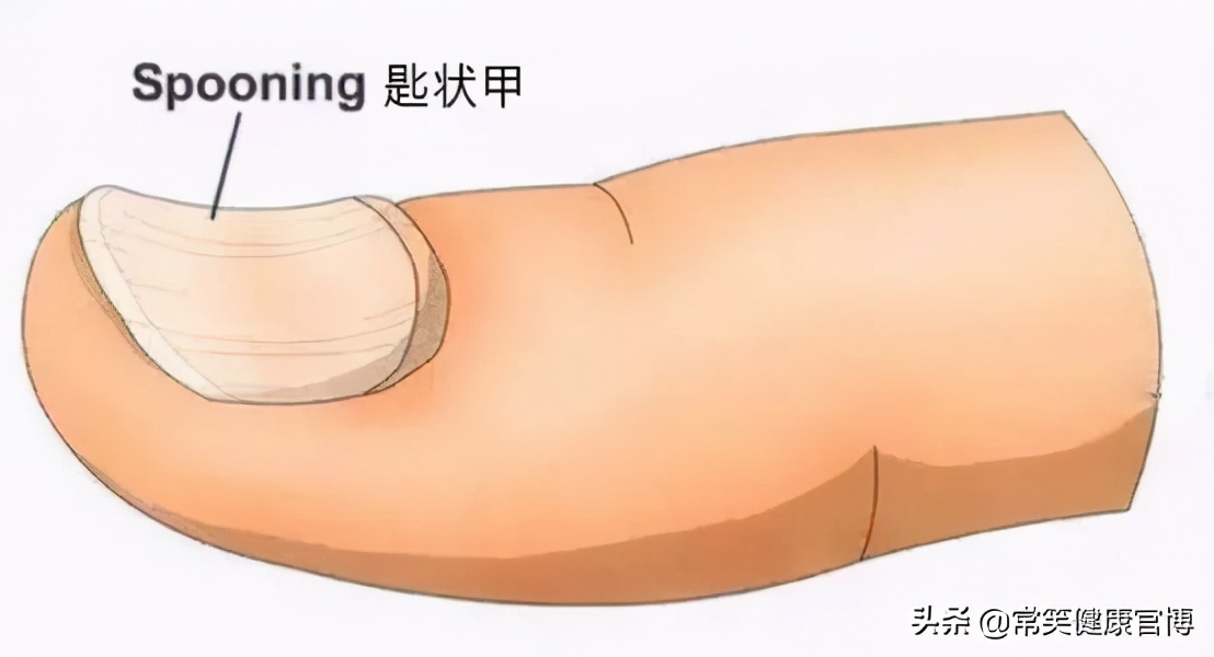 指甲出现各种问题的图片,指甲出现这些症状可能是灰指甲