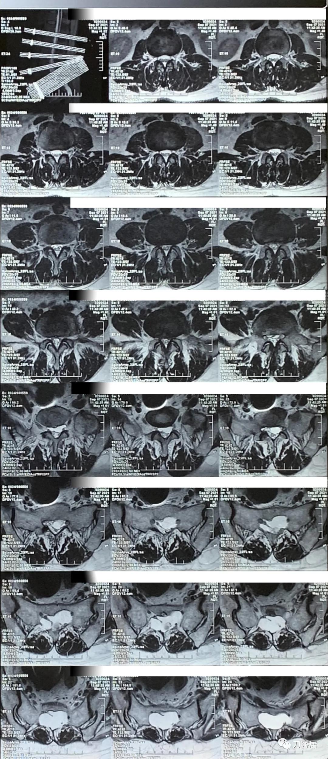 左下肢疼痛病历,门诊腹痛病历