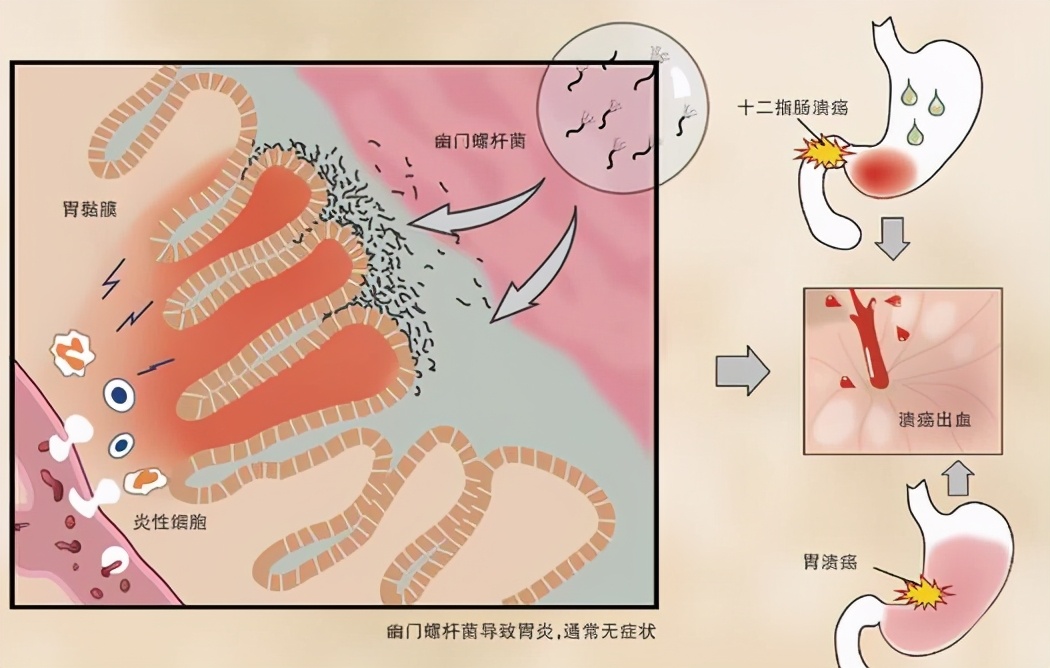 饭后2至3小时胃疼胃溃疡怎么了,饭后上腹部疼胃溃疡
