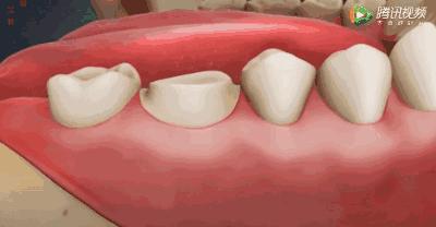 根管治疗可怕,根管治疗很恐怖吗