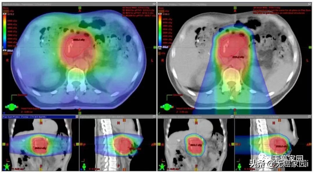 质子治疗消化道肿瘤,质子重离子治疗肠胃瘤