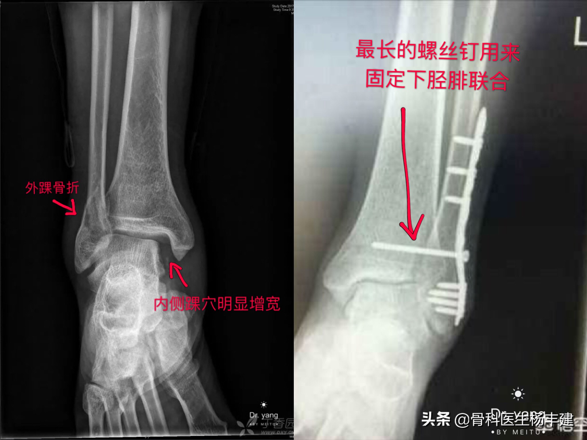 什么样的脚踝骨折适合保守治疗,什么样的腿骨骨折需要手术
