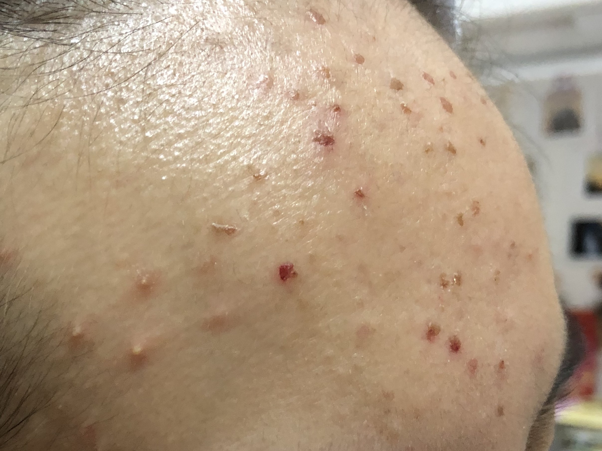 17岁女儿脸上长很多痘痘粉刺,12岁女儿脸上长满痘痘怎么办