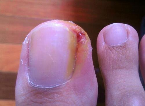 啃指甲拔倒刺危害,手指拔肉刺甲沟炎化脓怎么治