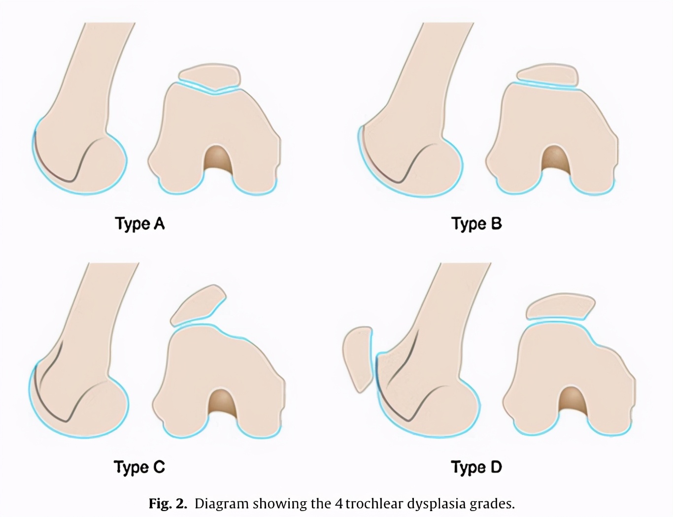 髌骨半脱位打石膏能彻底治愈吗,青少年膝盖半月板二级损伤