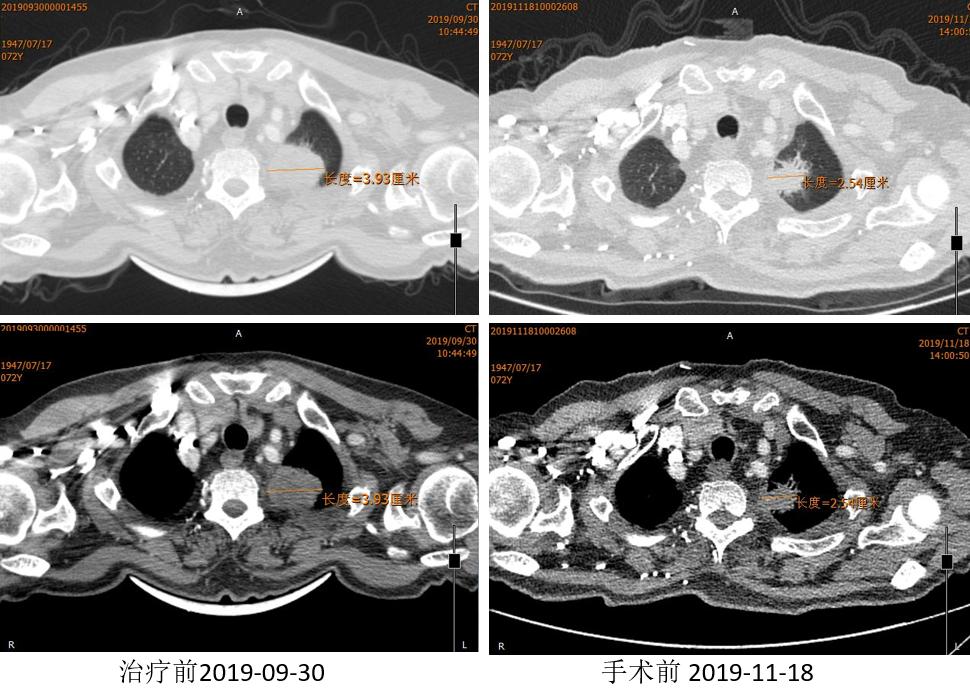 PD-1新辅助治疗初探，典型案例汇总一览