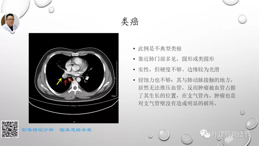 叶建明谈肺实性小结节视频,廖正银教授谈肺结节