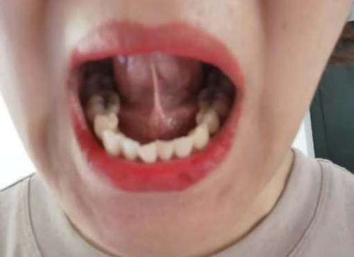 治疗一例咽痛如刀割状、牙痛、唇部疱疹者，一副药未尽剂而愈。