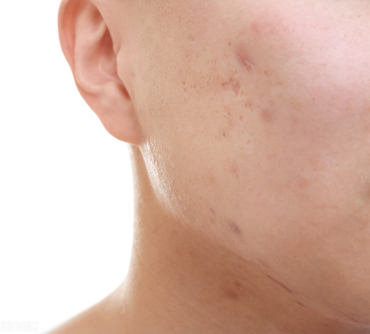 皮肤瘙痒起疙瘩不能吃什么,皮肤瘙痒起疙瘩妙招