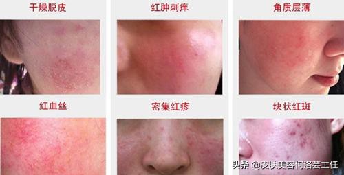 皮肤屏障受损怎么急救,皮肤屏障受损发红发烫用什么修复