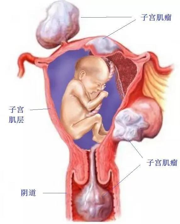 当孕妈妈遇上了子宫肌瘤,剖腹产遇上子宫肌瘤