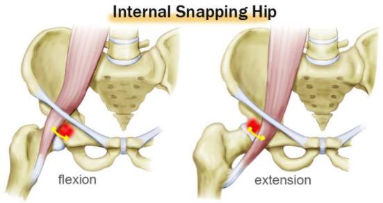 练腹部髂腰肌疼痛怎么恢复,髂腰肌训练时腹股沟疼痛是为什么