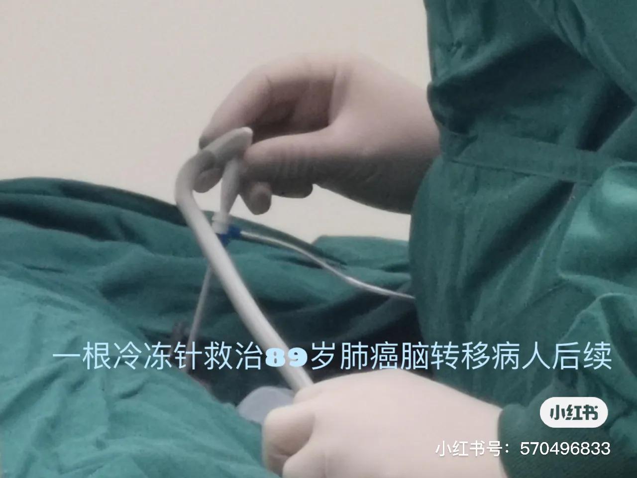 一个冷冻针救治89岁肺癌脑转移病人后续