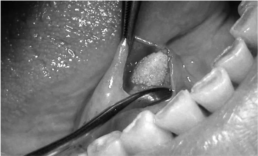 36岁女子一吃饭下巴就痛，这是什么怪病？医生：嘴巴里有个石头