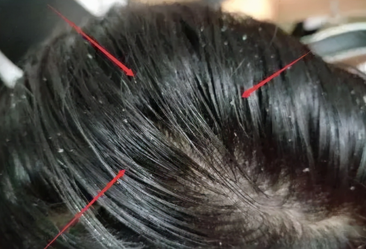 头皮上长红疙瘩脓包涂什么药膏,头皮起红色小疙瘩有脓包怎么治