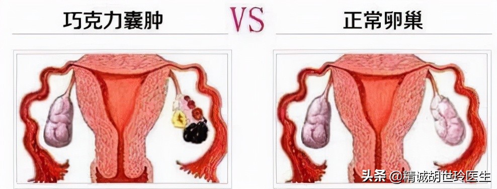 炎性卵巢囊肿和巧克力囊肿的区别,巧克力囊肿是做手术还是试管