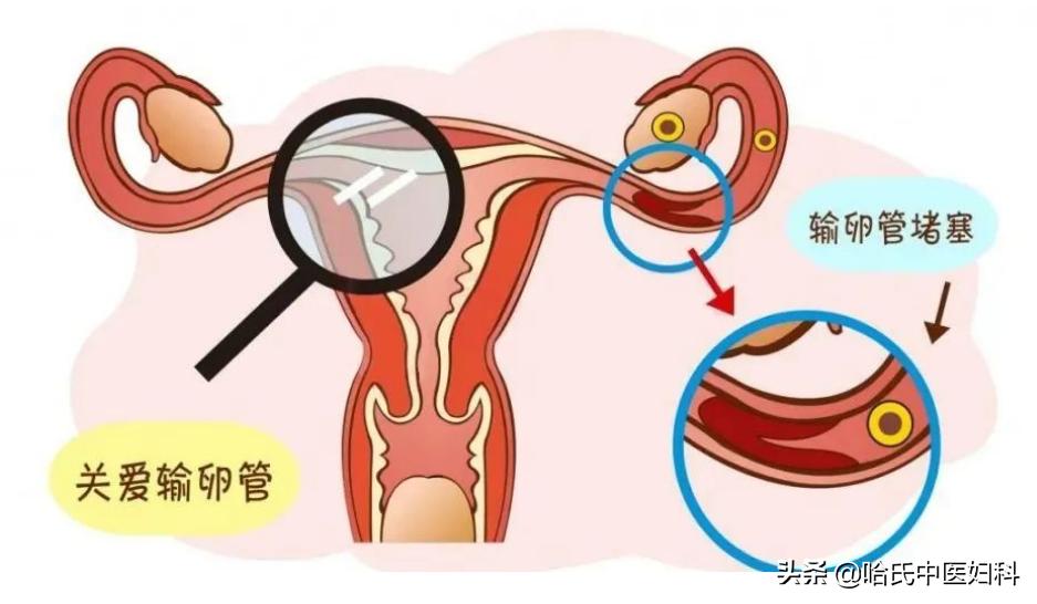 29岁输卵管堵塞怀孕,结婚流产一回会输卵管堵吗